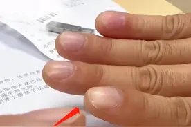 手指肿成“萝卜头”，一查竟是肺癌！手指异常信号，要多留心图片