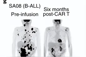 国研新型CAR-T完成首例回输！剑指肝癌、脑瘤、血癌等图片