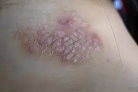 轻轻松松帮你解决神经性皮炎！图片