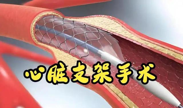 医生提醒：做过心脏支架手术，身体若出现这几种异常，要当心。