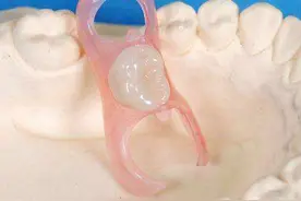 牙齿缺失后的三种镶牙方式对比图片