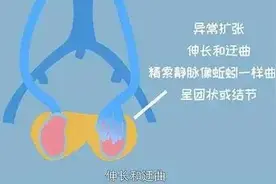精索静脉曲张的秘密，暴漏了！图片