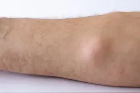 数个核桃大的脂肪瘤消失！老中医一张方，化痰消瘤，标本兼治！图片