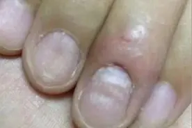 大连7岁女童指甲凹凸不平，竟是因为……图片