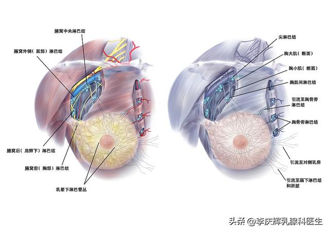 乳腺癌常见的转移部位