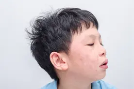 6岁娃使用阿奇霉素后全身长皮疹！医生提醒：一定要警惕药物过敏图片