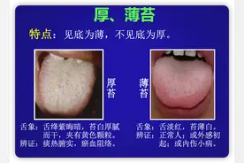 中医状元：舌苔的薄、厚、润、燥、腻、腐和剥落，9种苔图片