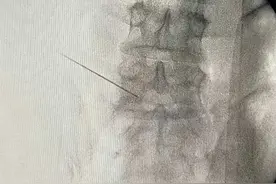 长治市中医医院疼痛科：椎间盘射频消融术治疗腰椎间盘突出症图片