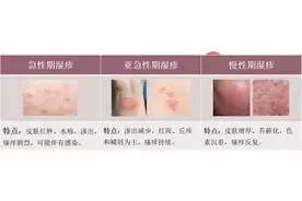 湿疹反复发作？针对不同时期的治疗策略，教你如何有效缓解症状图片