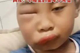 暑假回老家，孩子太好奇被蜜蜂蛰“毁容”，医生提醒：三步处理图片