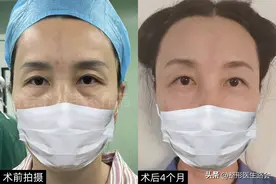 48岁去做泪沟填充，熬过了恢复期，说几个大家不知道的“内幕”！图片