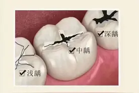 牙齿烂到什么样的情况下，才需要做根管？图片