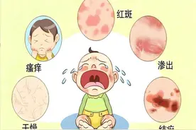 皮肤病症茶疗法——湿疹图片