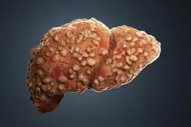 肝硬化离肝癌只有一步之遥！早期肝硬化有5个信号，早发现早治疗图片