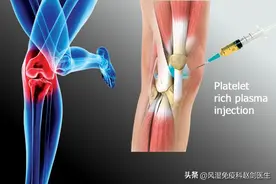 PRP是一种什么治疗？对膝骨关节炎患者有何帮助？图片