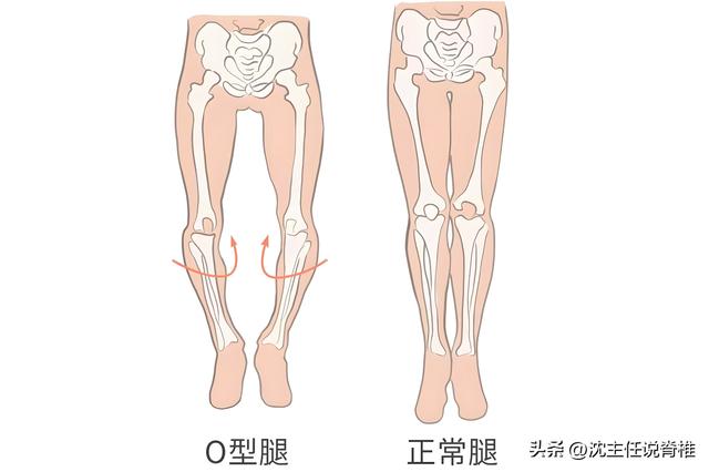 “O型腿”腿不直，应该如何矫正？每天8个动作，夏天露腿不再尴尬