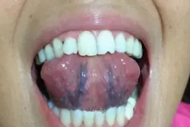 舌头下的青筋又黑又紫，是有淤血吗？图片