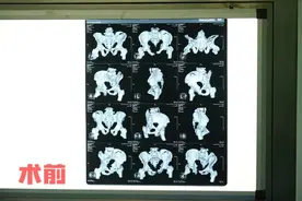 山西首例 ▏京长对口合作再结硕果——长治二院成功开展机器人辅助下全自动骨盆骨折微创复位内固定技术图片