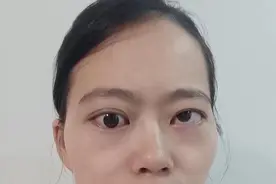 女孩甲亢右眼突出，用杞菊地黄丸加减，9个月得以控制图片