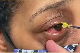 502胶溅到3岁男孩眼中，爸爸60秒紧急处理获赞，医生：幸亏你懂！图片