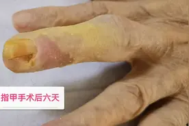 恢复中的指甲（接上周）图片