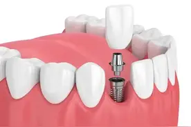 比种植牙便宜，比活动牙牢固，这种修复方式咀嚼性好，吸附性强！图片