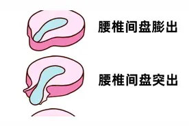 有人说腰椎间盘膨突出症就是痊愈了也不能干重活到底对不对这句话图片