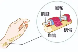 腱鞘炎是怎么形成的 你清楚吗？图片