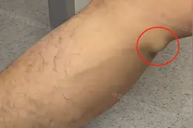 小腿有鼓起来的包，走两步就酸痛瘙痒，是长肿瘤了吗？图片