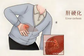 医生发现：每天运动的肝硬化患者，用不了多久，身体会有4大改善图片