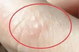 痒痒痒！一到夏天手上就长出的“小水泡”到底是啥？怎么治？图片