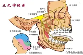 三叉神经痛，到底需不需要手术治疗？图片
