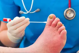 脚趾缝烂了，很痒，还脱皮，如何来拯救？听医生怎么说图片