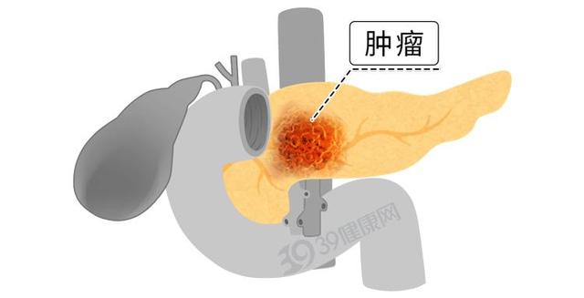 胰腺癌大户被揪出，是烟酒的2倍！医生：经常吃，胰腺或扛不住