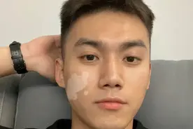 震惊！北京一位白癜风专家居然攻克了白癜风！图片