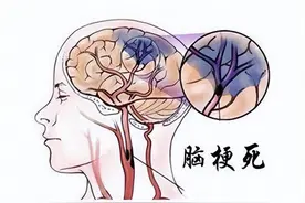 为何“脑梗”易二次复发？多半是这3件事做太多，很多人都忽视图片