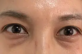 眼袋严重先别急着切!眼袋不分“真假”就做切除只会变更丑图片
