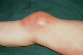 滑膜肉瘤：一种专挑年轻人下手的恶性肿瘤，该如何有效预防？图片