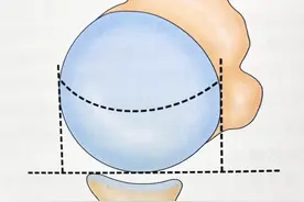 干货｜巨大及不可修复肩袖损伤治疗详解图片