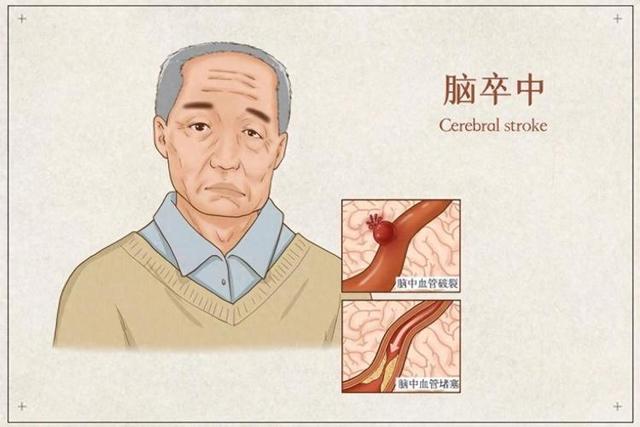 北京协和研究：他汀联用依洛尤单抗，有助消退颅内动脉粥样斑块！