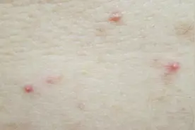 看又看不到，搓也够不着，后背上的痘，到底该怎么祛？图片