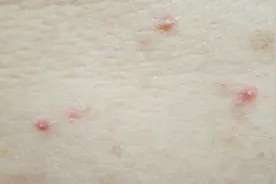 看又看不到，搓也够不着，后背上的痘，到底该怎么祛？图片