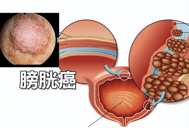 医生提醒：出现这种尿，可能有肿瘤！这些预警信号，别忽视了