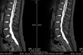 打死都不相信！治好腰突竟然这么简单，每天才花几块钱太划算了！图片