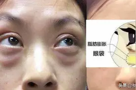 眼袋怎么才能消除图片