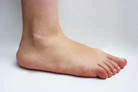 儿童扁平足是残疾吗？有矫正的希望吗？图片