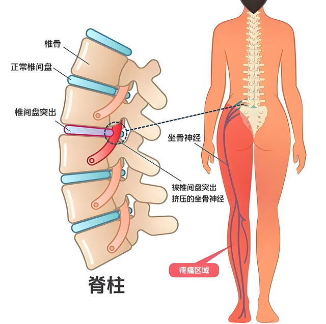 踝关节扭伤不是"小问题"：3个病例展示如不注意，多年后代价几何