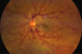 糖尿病患者，看东西有这6个表现，可能是眼底病变，请尽快就医！图片