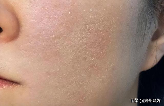 一脱衣服身上很多皮屑脱落，怎么回事？是缺维生素了？涨知识了！