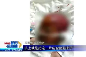 六岁男童特重度烧伤 重症监护室治疗 母亲满眼含泪自责不已图片